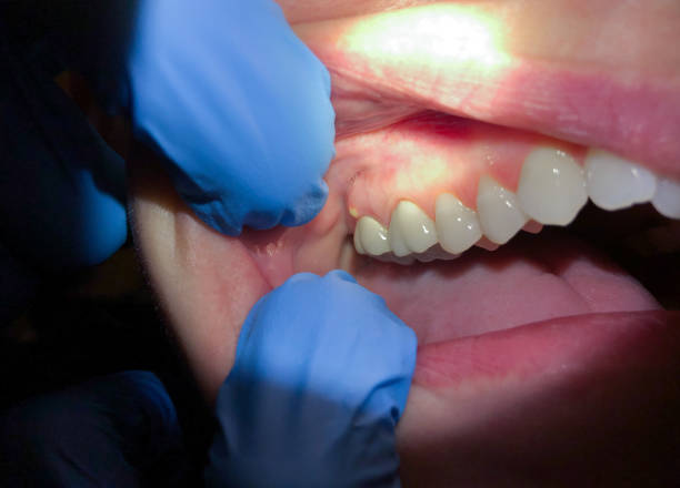 Best Urgent Care for Lost Fillings or Crowns in Schler Park, IL